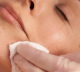 Kjemisk peeling